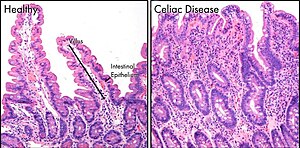 celiac disease histology
