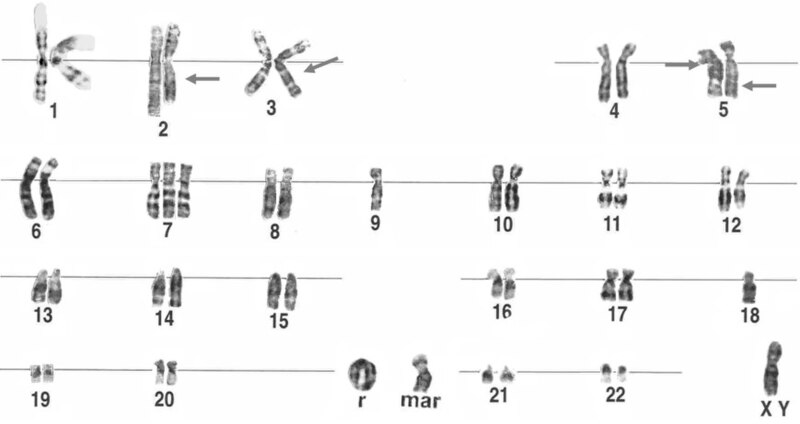 File:Human karyotype from bladder carcinoma, including ring chromosome.jpg