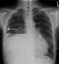 Thumbnail for Hydropneumothorax