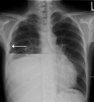 Hydropneumothorax