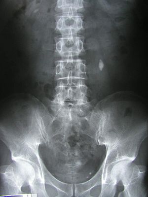 Рентгенограма, на якій видно камінь (конкремент) у лівому сечоводі