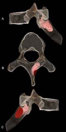 Image du vertèbre du spécimen MH1, la zone en rose correspondant à la présence d'une tumeur.