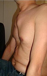 An anterior chest wall deformity, pectus excavatum, in a person with Marfan syndrome