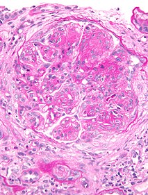 Membranoproliferative glomerulonephritis Human disease