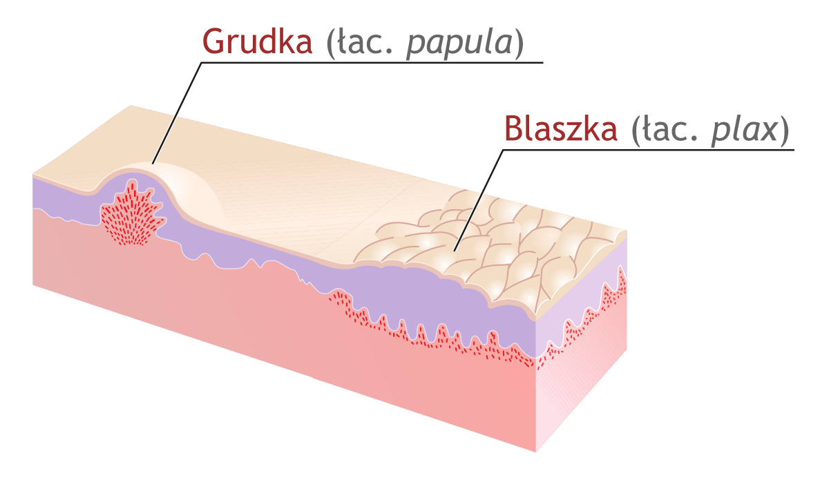 papule plaque