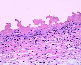 Pericarditis fibrinosa