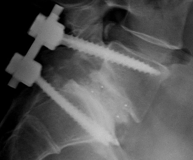 Cervical adjacent segment disease: Risks and complications