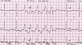 Taşikardi ventricolare non sostenuta.JPG