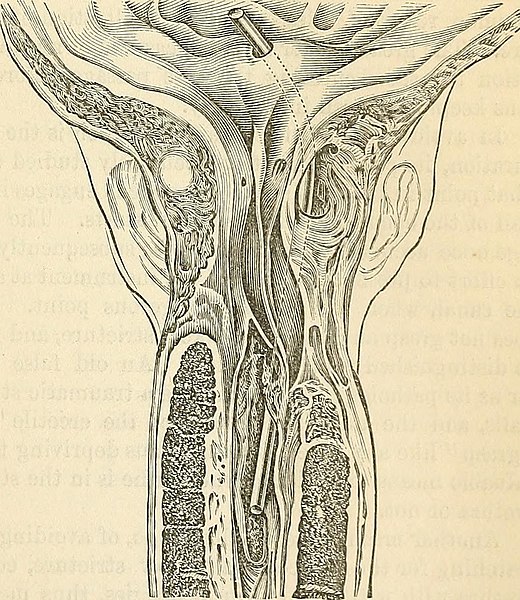 File:The surgical diseases of the genito-urinary organs including syphilis (1889) (14594820127).jpg