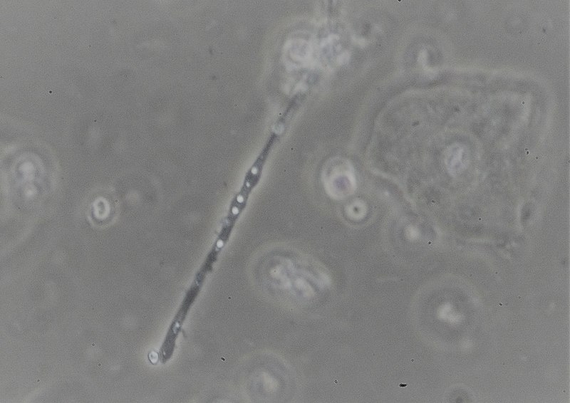 File:Vaginal swab wet mount of candida.jpg