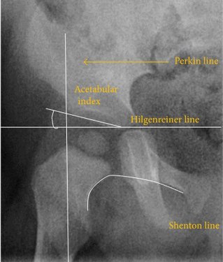 Figure 2A. Normal hip.[1]
