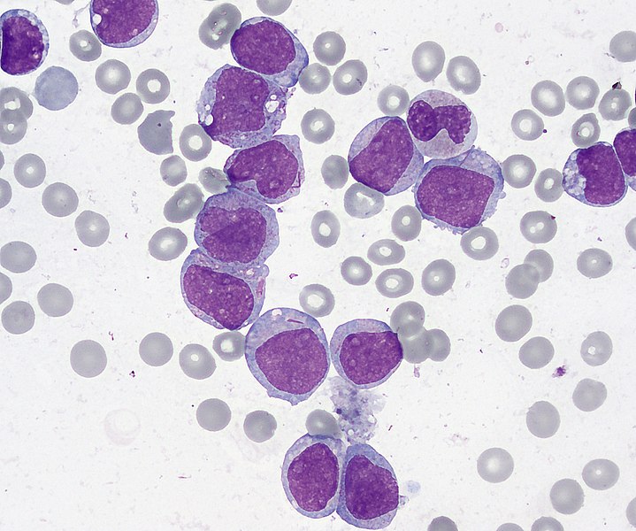 File:Acute Myelogenous Leukemia with maturation.jpg