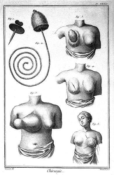 File:Amputation of breast with instruments Wellcome L0002717.jpg