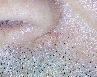 Basal-cell Carcinoma.jpg