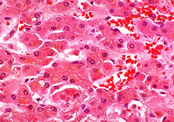 Histopathology of liver showing alcoholic hyal...