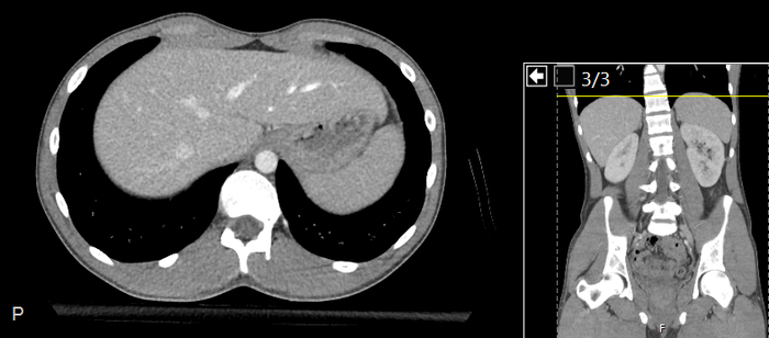 CT of a normal abdomen and pelvis, axial plane 39.png