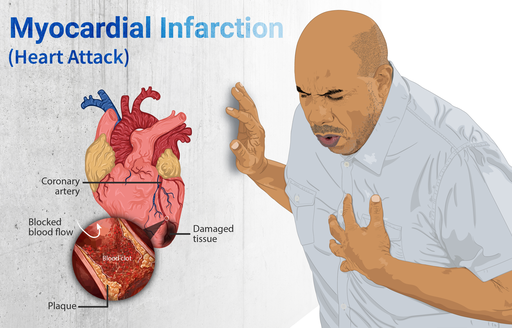 Depiction of a person suffering from a heart attack (Myocardial Infarction)