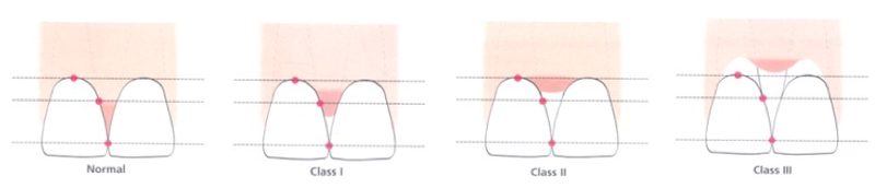 The classification of the amount of gum that fills the spaces between the teeth Embrasure spaces.png