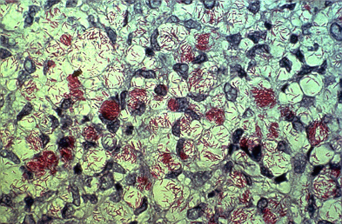 Mycobacterium leprae