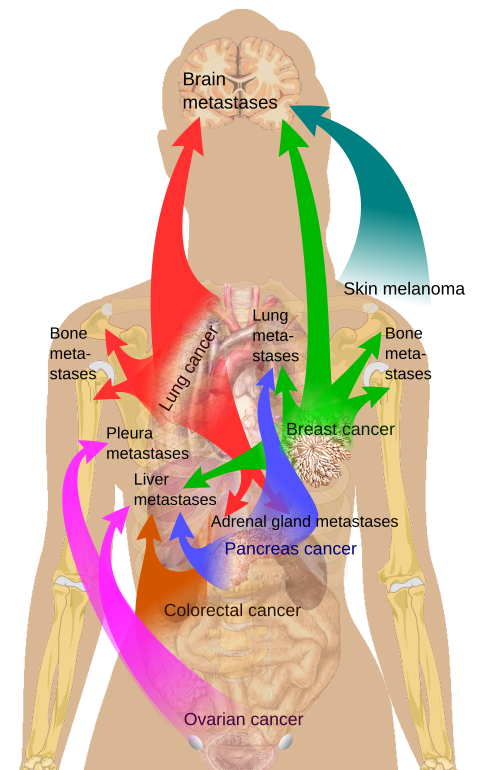Main sites of metastases for some common cancer types.