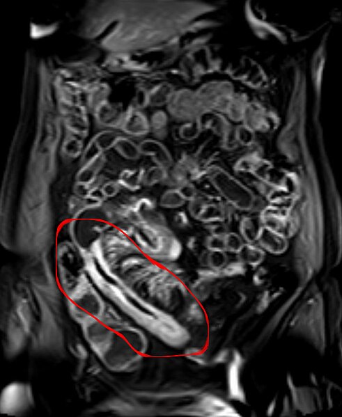 File:Morbus Crohn MR-Sellink T1FSKM cor.jpg