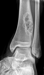 Nonossifying fibroma