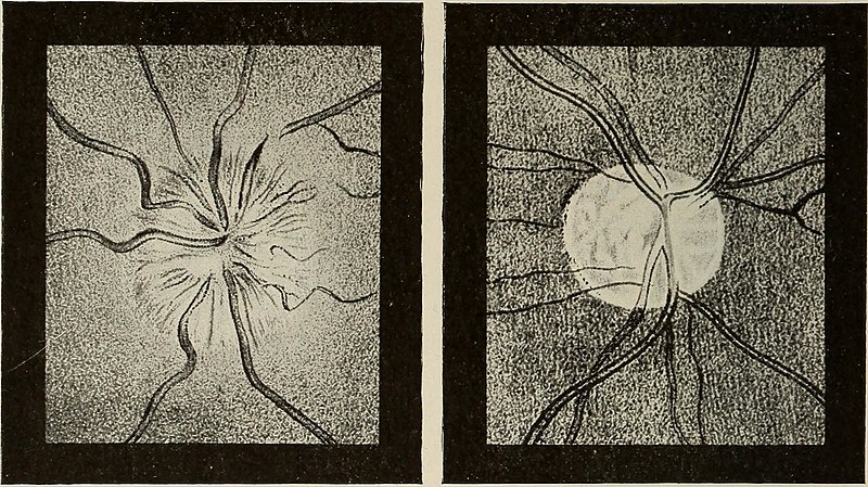 File:Nervous and mental diseases (1919) (14758466766).jpg