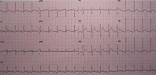 Pericarditis pericardium disease that is characterized by an inflammation of the pericardium and has symptom chest pain