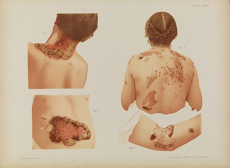 File:Plate XXVII, lesions, back & arms Prince Albert Morrow, 1889 Wellcome L0074352.jpg