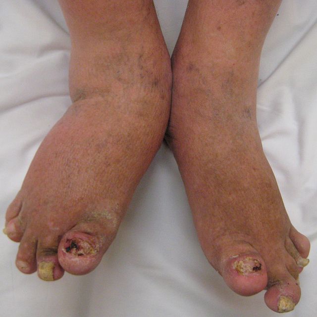 a lábujjak rheumatoid arthritis