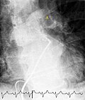 Thumbnail for Pulmonary angiography