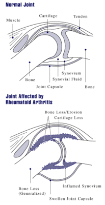 Rheumatoid arthritis joint.gif