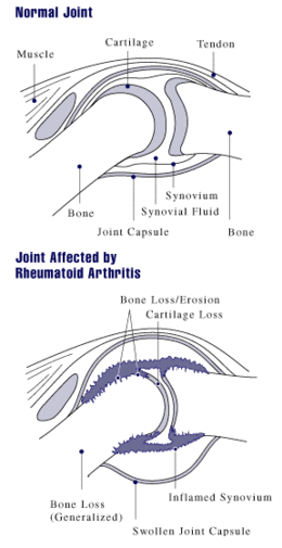 A diagram showing how rheumatoid arthritis affects a joint Rheumatoid arthritis joint.gif