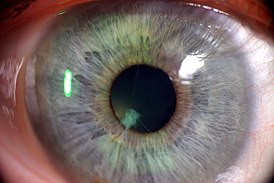 Rkinch persistent pupillary membrane.jpg