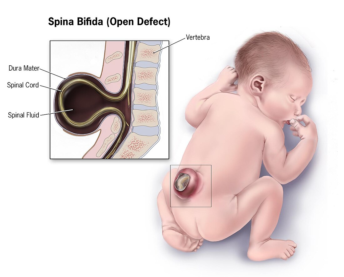 Neural tube defect