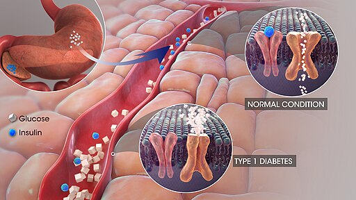 3D medical animation still of Type One Diabetes