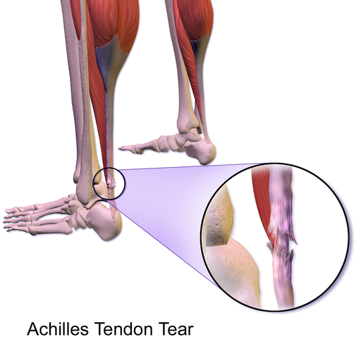 Achilles Tendon Tears can make your lower calves hurt when running