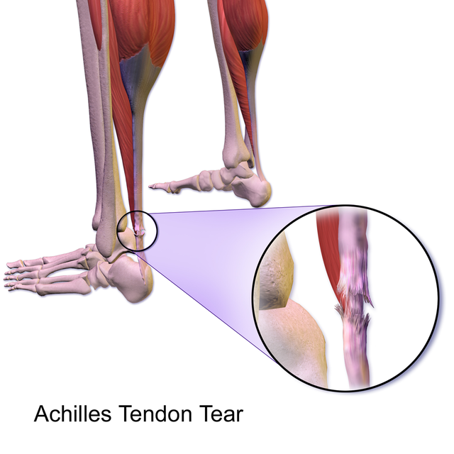 Chronic Achilles Tendon Pain: Diagnosis & Treatment