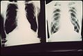 BLACK LUNG X-RAYS FROM PATIENTS OF DR. A.H. RUSSAKOFF PULMONARY DISEASE SPECIALIST AND PIONEER AIR POLLUTION FIGHTER... - NARA - 545474.jpg
