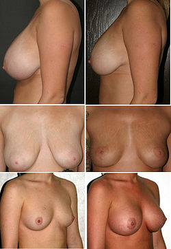 Breast Cosmetic Procedures.jpg