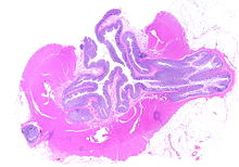 Whole slide of a transverse section of the left colon with diverticulosis Colon diverticulosis whole slide.jpg