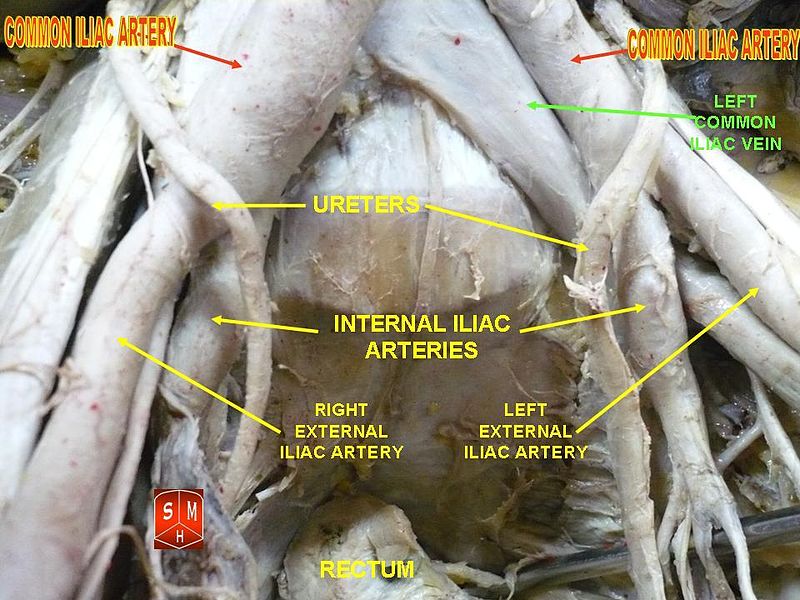 파일:Common iliac artery.jpg