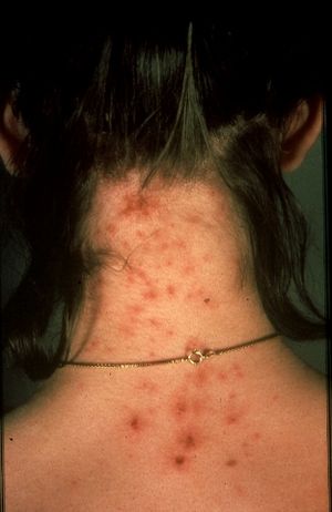 Head lice infestation - Wikipedia