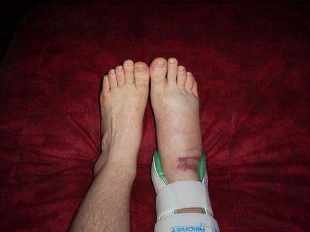 Right foot, housed in an air brace, has become swollen as a result of a more severe 2nd degree sprain to the ankle.