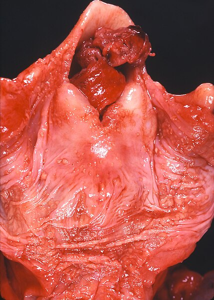 File:Larynx - Aspiration of a large fragment of meat.jpg