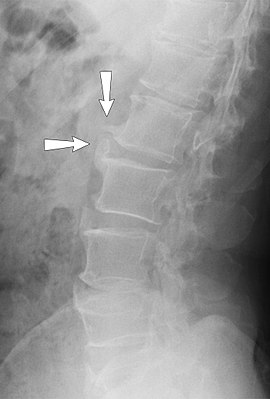 Lateral X-ray of lumbar spine spondylosis.jpg