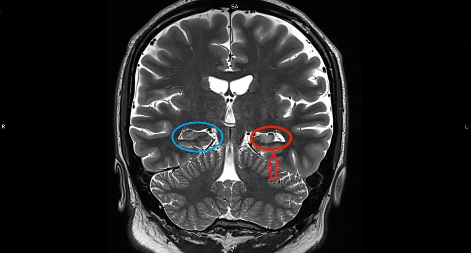 Chronic traumatic encephalopathy - Wikipedia