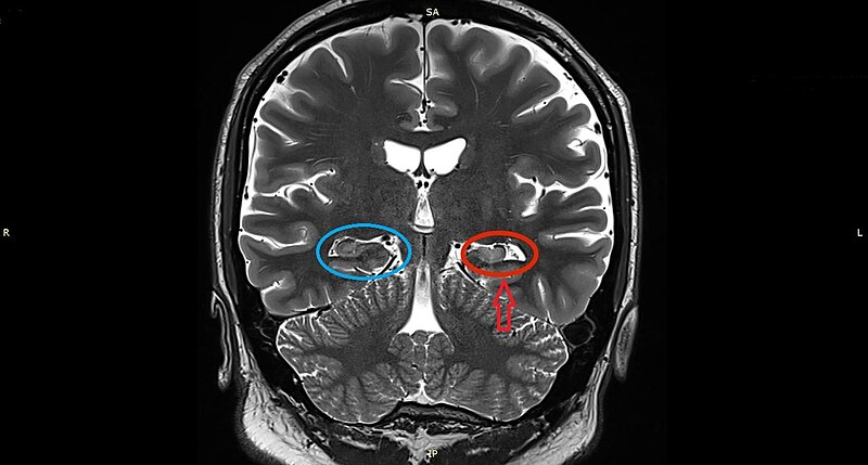 File:Left Hippocampal Sclerosis on MRI.jpg