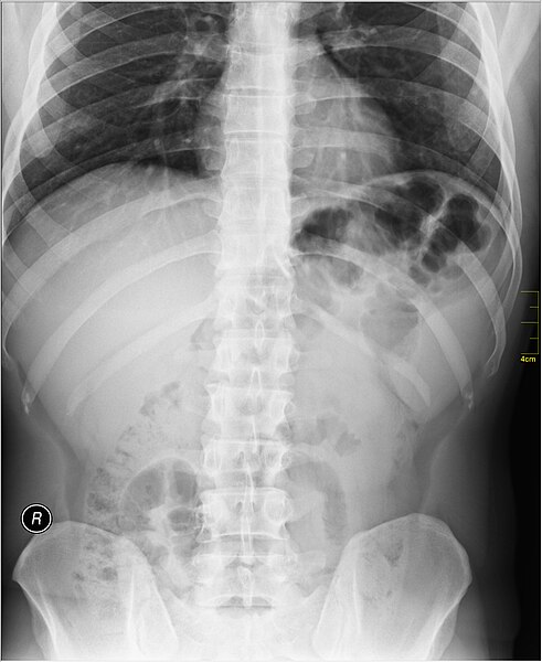 File:Medical X-Ray imaging OAO06 nevit.jpg