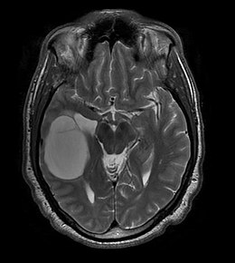 Oligodendroglioma 006.jpg